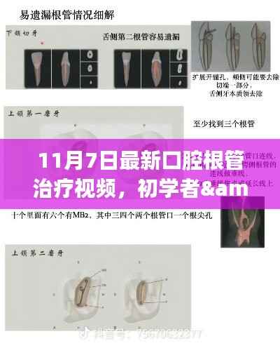 最新口腔根管治疗视频教程,初学者与进阶用户步骤详解(11月版)
