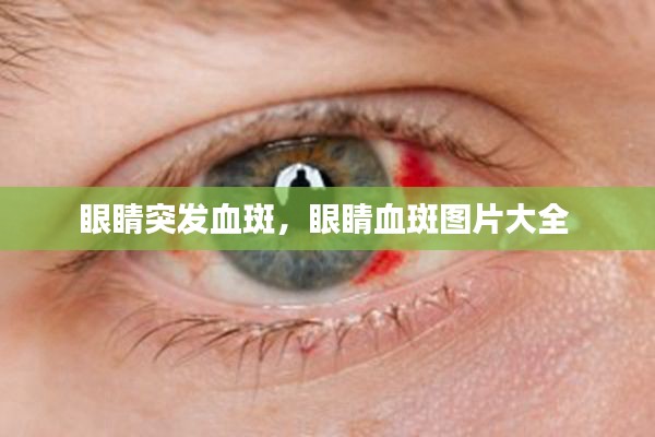 眼睛突发血斑,眼睛血斑图片大全